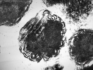M,12y. | mast cell - granules with scroll-like formations - skin, urticaria pigmentosa M,12y. | mast cell - granules with scroll-like formations - skin, urticaria pigmentosa
